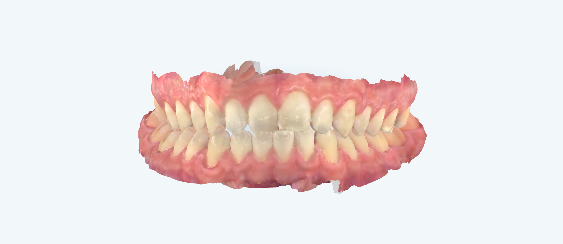 Underbite treatment comparison angled side view before